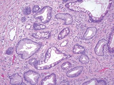 Fig. 6.49, Invasive mucinous carcinoma, gastric type. Occasionally goblet cells may be present.