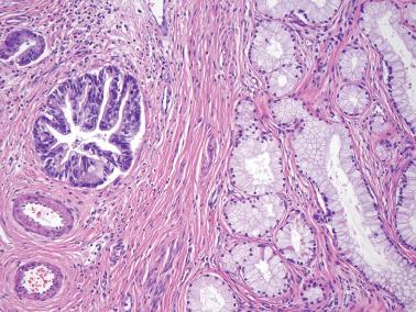 Fig. 6.50, Invasive mucinous carcinoma, gastric type. Glands showing overt cytologic atypia (left) contrast starkly with the adjacent well-differentiated glands (right).