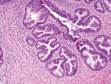 Fig. 6.5, Adenocarcinoma in situ. The involved glands show marked cellular stratification, mitoses, focal basilar apoptosis, and apical snouting.