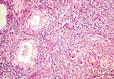 Fig. 6.51, Invasive mucinous carcinoma, gastric type (adenoma malignum). Some well-differentiated glands merge with poorly differentiated adenocarcinoma.