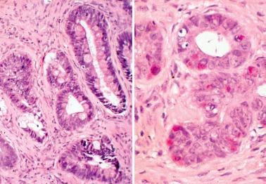 Fig. 6.52, Endocervical mucinous adenocarcinoma, intestinal type. Note goblet cells (left) and argentaffin cells with red cytoplasmic granules (right).