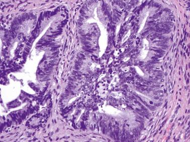 Fig. 6.6, Adenocarcinoma in situ. A cribriform pattern is seen as are apoptotic bodies and apical (‘floating’) mitoses.