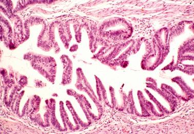 Fig. 6.7, Adenocarcinoma in situ. The neoplastic cells line intraglandular papillae.