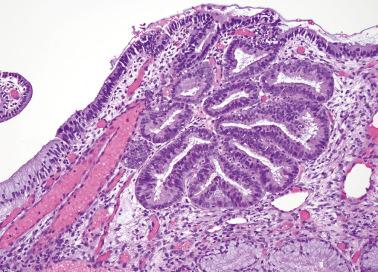 Fig. 6.8, Adenocarcinoma in situ. Surface involvement as well as involvement of a lobule of glands are seen.