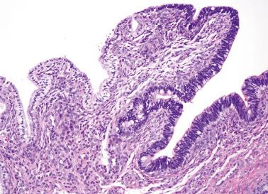 Fig. 6.9, Adenocarcinoma in situ, surface involvement.