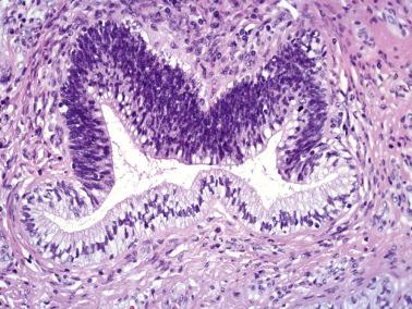 Fig. 6.10, Adenocarcinoma in situ. Partial involvement of a gland.