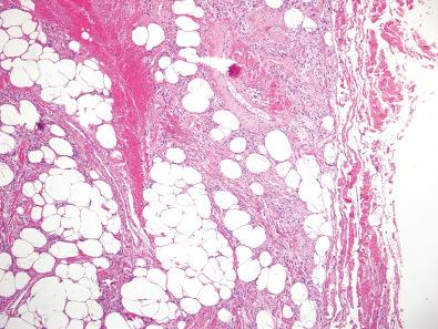 Figure 12.13, Spindle Cell Lipoma.