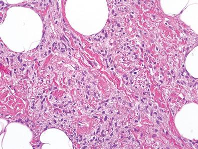 Figure 12.14, Spindle Cell Lipoma.