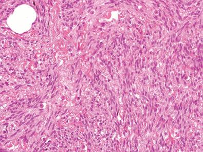 Figure 12.15, Spindle Cell Lipoma.