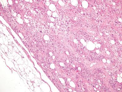 Figure 12.17, Pleomorphic Lipoma.