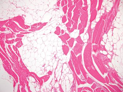 Figure 12.3, Intramuscular Lipoma.