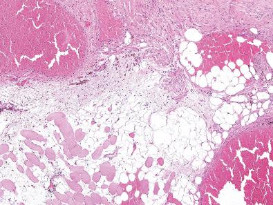 Figure 12.5, Intramuscular Angioma.