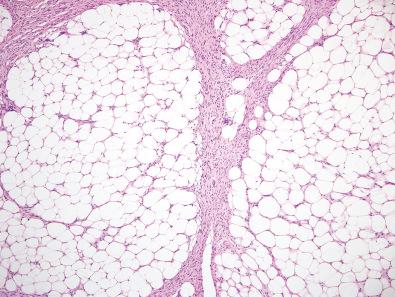 Figure 12.6, Lipofibromatosis.