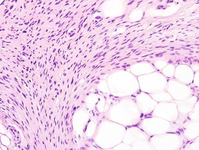 Figure 12.7, Lipofibromatosis.