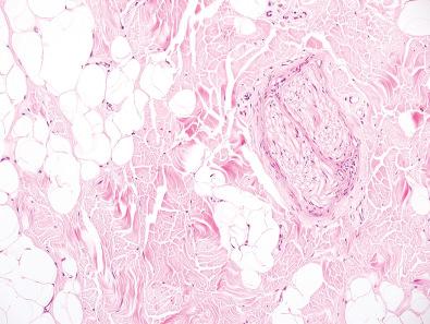 Figure 12.8, Lipomatosis of Nerve.