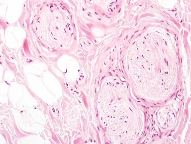 Figure 12.9, Lipomatosis of Nerve.