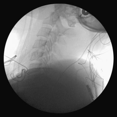 FIGURE 55-1, Needle localization of C6 and C7 in preparation for C6-7 anterior cervical diskectomy and fusion.