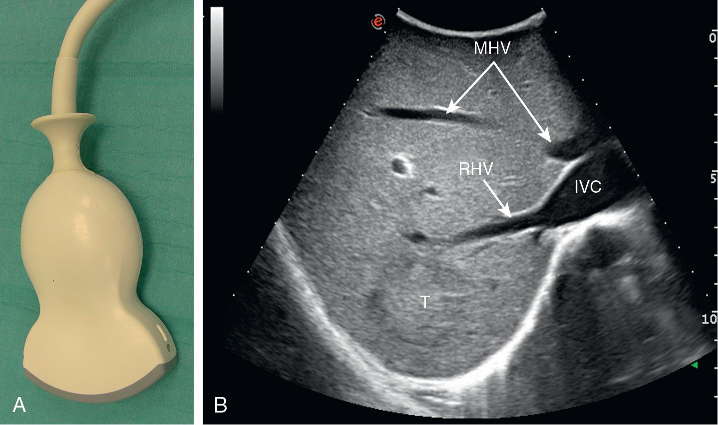 FIGURE 103.1, A, Convex probe for percutaneous exploration used intraoperatively for an initial overview. The relatively low frequency allows visualization of deep structures, although it offers some degree of spatial resolution. B, Appearance of a convex probe scan. In one scan, it is possible to visualize the liver with a tumor (T) and to recognize the middle hepatic vein (MHV), the right hepatic vein (RHV), and the retrohepatic inferior vena cava (IVC).