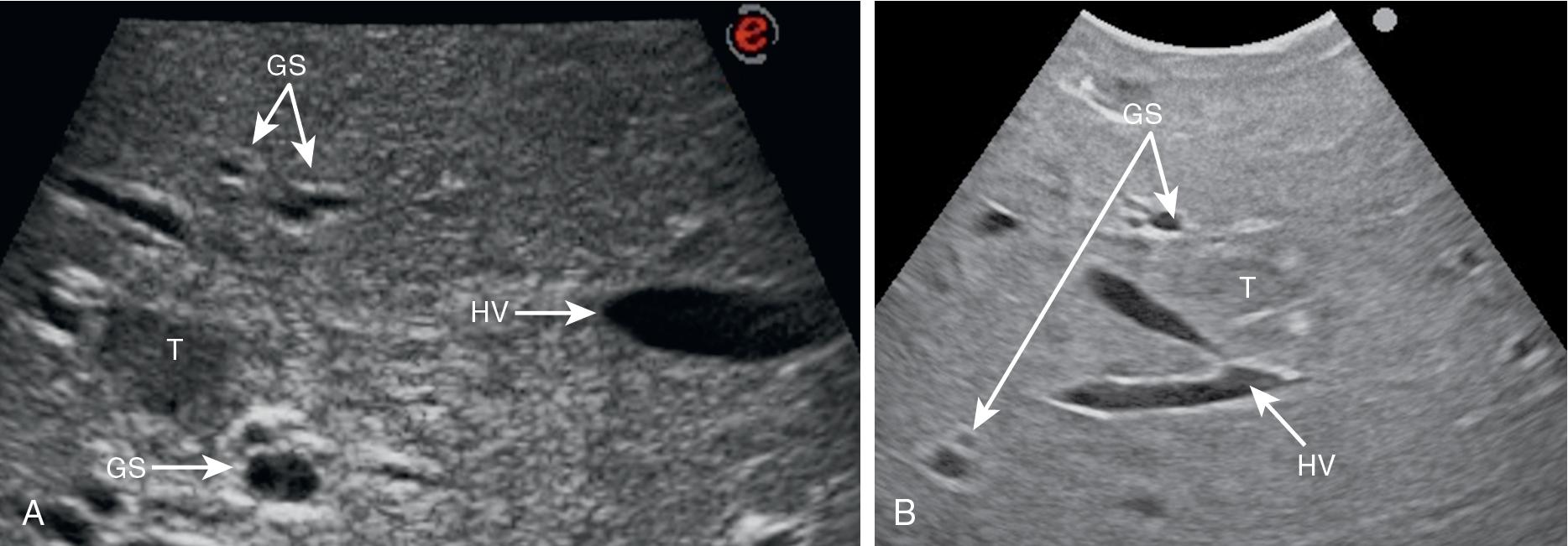 FIGURE 103.11, A, The Glissonean sheath (GS) and hepatic vein (HV) in a normal liver have a different wall thickness on intraoperative ultrasound. The GS is represented by at least two anechoic (black) structures, representing the artery and the portal vein; the bile duct is always seen in the case of the first- and second-order branches, which are often disclosed, particularly when dilated in the case of a more peripheral GS. B, In the cirrhotic liver, HVs have a thickened wall that mimics the wall of a GS; the anatomic landmarks and the inclusion of various structures together allow their proper differentiation. T , Tumor.