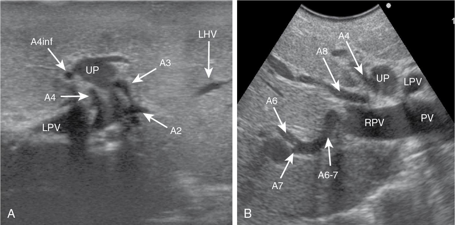 FIGURE 103.12, Arterial branching pattern in the left (A) and right (B) hemiliver. A2 , Arterial branch to segment II; A3 , arterial branch to segment III; A4 , arterial branch to segment IV; A4inf , arterial branch to segment IV inferior; A6 , arterial branch to segment VI; A7 , arterial branch to segment VII; A6-7 , arterial branch to the right posterior section; A8 , arterial branch to segment VIII; LHV , left hepatic vein; LPV , left portal vein; PV , portal vein; RPV , right portal vein; UP , umbilical portion.