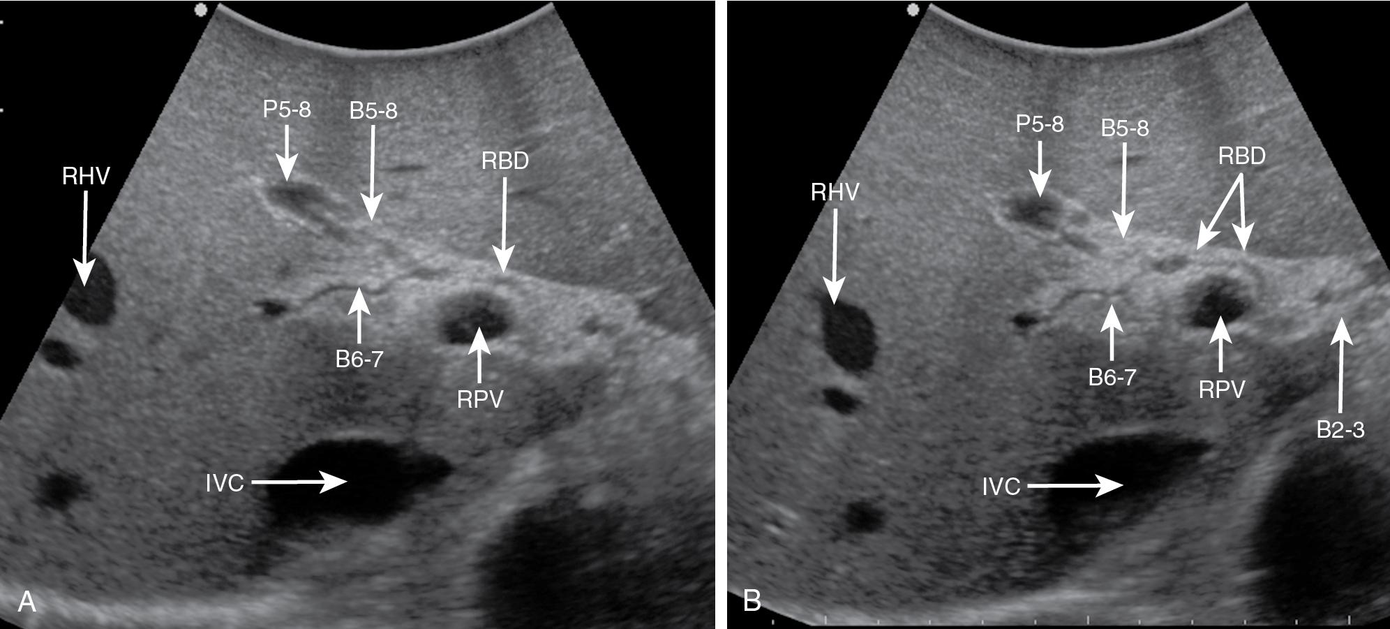 FIGURE 103.13, The biliary branching pattern in the right hemiliver (A), and partially the left (B). B2-3 , Bile duct to segments II and III; B5-8 , bile duct to right anterior section; B6-7 , bile duct to right posterior section; LPV , left portal vein; MHV , middle hepatic vein; P5-8 , portal branch to right anterior section; RBD , right bile duct; RHV , right hepatic vein; RPV , right portal vein.