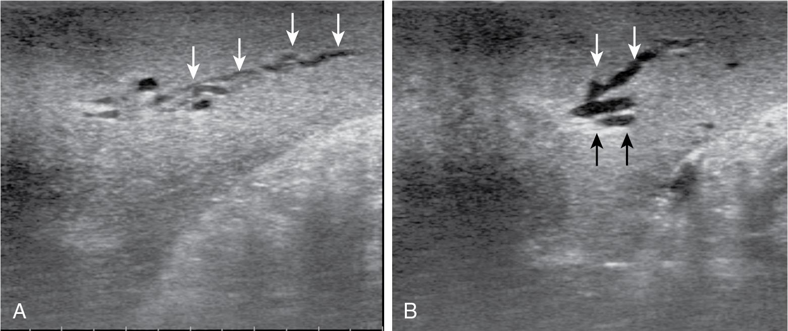 FIGURE 103.14, A and B show the dilation of segmental bile ducts, which assumes a serpiginous path (arrows).