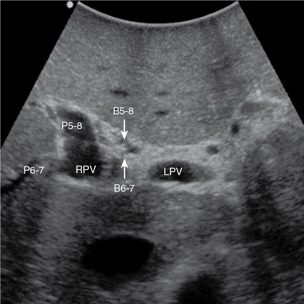 FIGURE 103.15, Centripetal branching pattern of the bile duct compared with that of the portal vein. B5-8 , Bile duct to right anterior section; B6-7, bile duct to right posterior section; LPV , left portal vein; P5-8, portal branch for right anterior section; P6-7, portal branch to right posterior section; RPV , right portal vein.