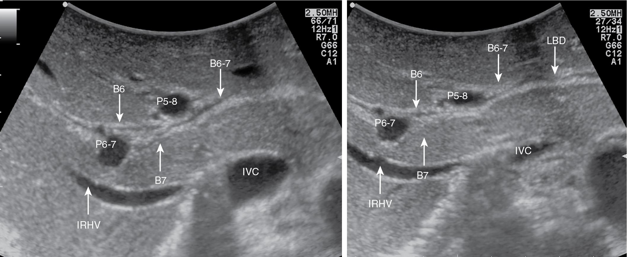 FIGURE 103.16, A, The confluence of the segmental bile ducts of segments VI (B6) and VII (B7) into the sectional bile duct of the right posterior section (B6-7) ; B, B6-7 is flowing into the left bile duct (LBD) as shown in this figure. IRHV , Inferior right hepatic vein; IVC , inferior vena cava; P5-8, portal branch for right anterior section; P6-7, portal branch to right posterior section.