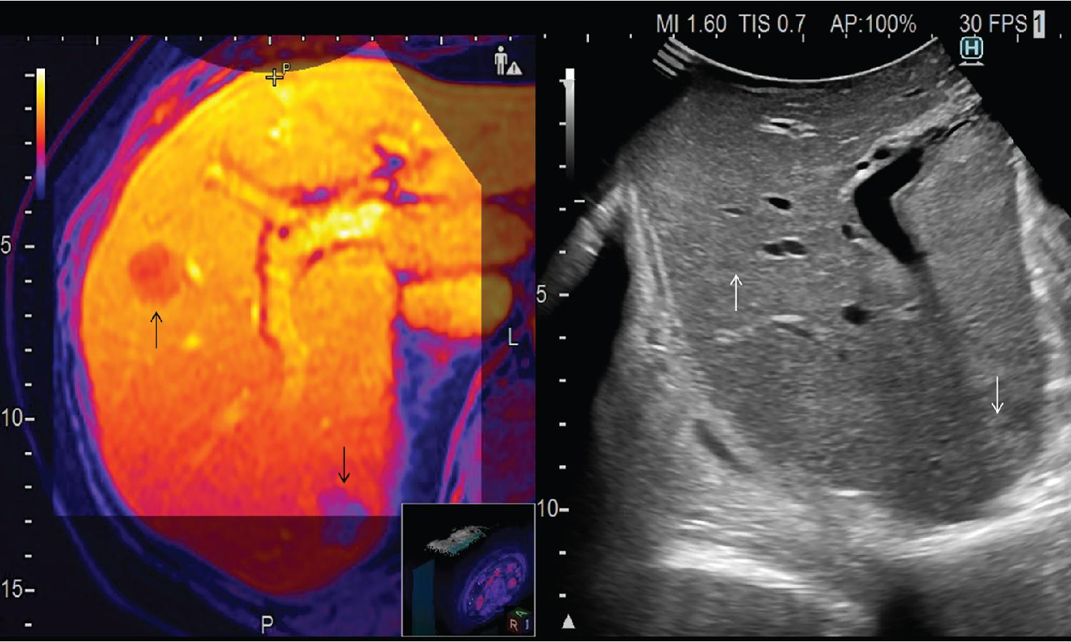 FIGURE 103.17, Matching the computed tomography (CT) images (left side of the image) obtained before chemotherapy and uploaded in the ultrasound system before the operation, with those of intraoperative ultrasound (IOUS; right side of the image ) at surgery allows us to locate the disappeared colorectal liver metastases (black arrows in the CT image, white arrows in the IOUS image).