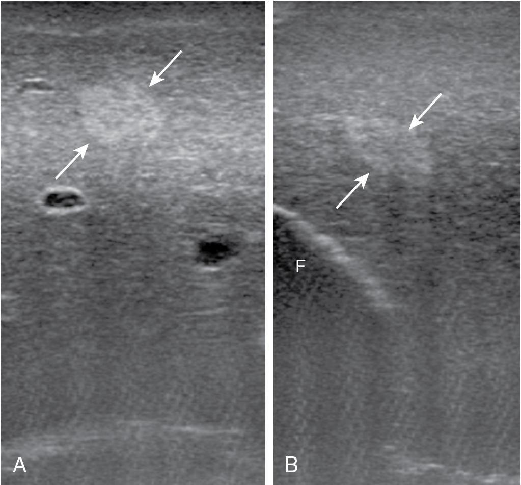 FIGURE 103.18, Test for diagnosing a hemangioma.