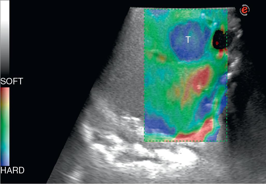 FIGURE 103.19, Potential value of elastography in estimating the tissue stiffness, relating it to a color scale disclosed on the left of each image. Tumor (T) as it appears at elastography; the tumor appears blueish, according to its higher stiffness compared with the surrounding liver parenchyma.