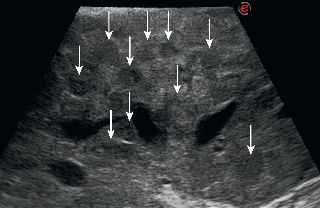 FIGURE 103.20, Cirrhotic liver with an inhomogeneous pattern as a result of the presence of an uncountable number of hypoechoic (dark) nodules mimicking tumors.