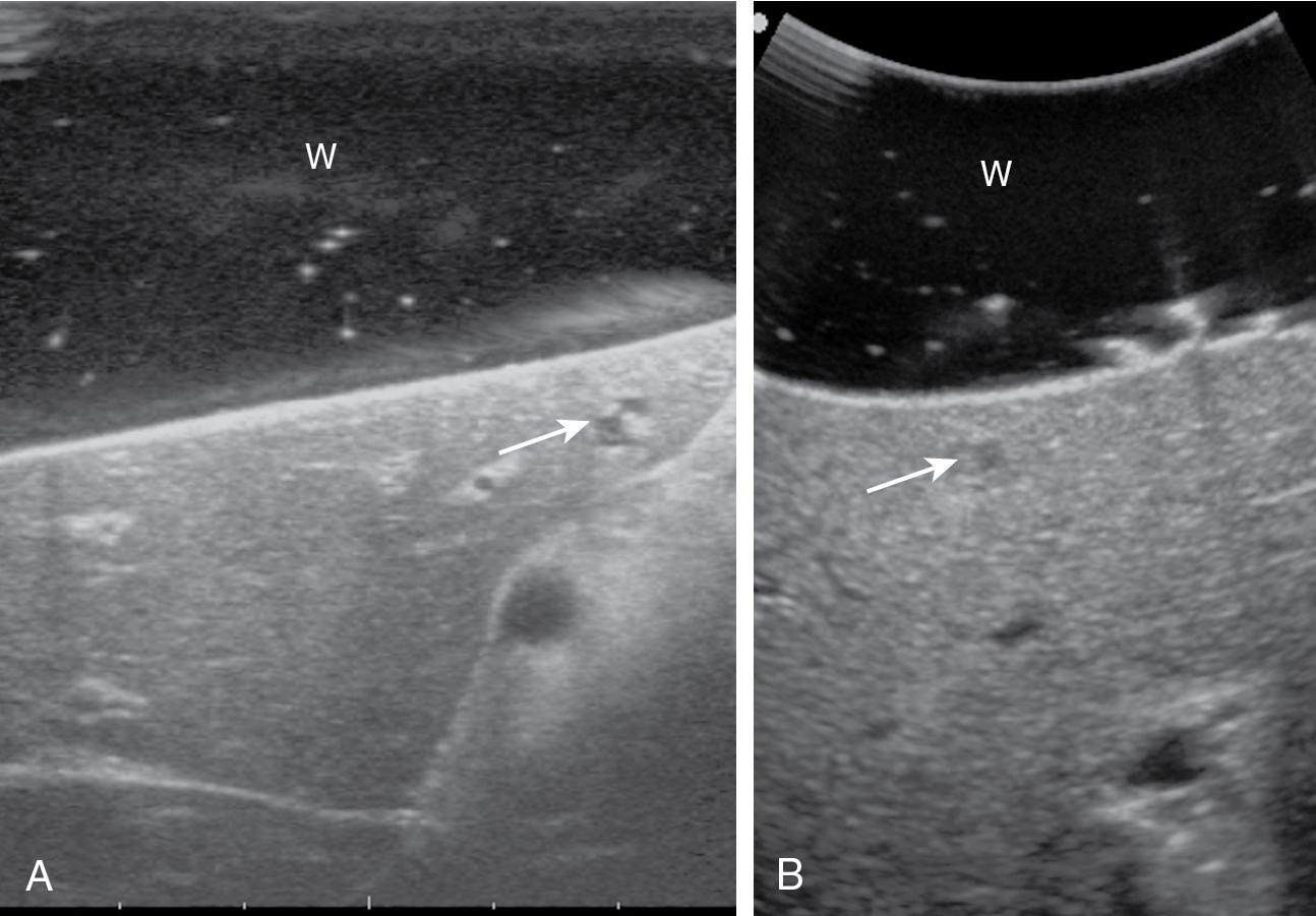 FIGURE 103.2, For better exploration of the superficial structures, a glove filled with deaerated water ( W ) is positioned in between the probe and the targeted surface. The arrows indicate two 1-mm lesions superficially located, a simple cyst (A), and a small colorectal liver metastasis (B).