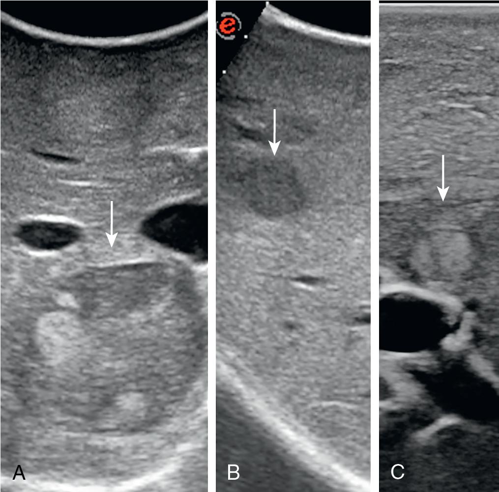 FIGURE 103.21, A, Nodule (arrow) with a mosaic pattern on intraoperative ultrasound (IOUS). B, Nodule (arrow) with a hypoechoic dark pattern at IOUS. C, Nodule (arrow) with a hyperechoic bright pattern at IOUS.