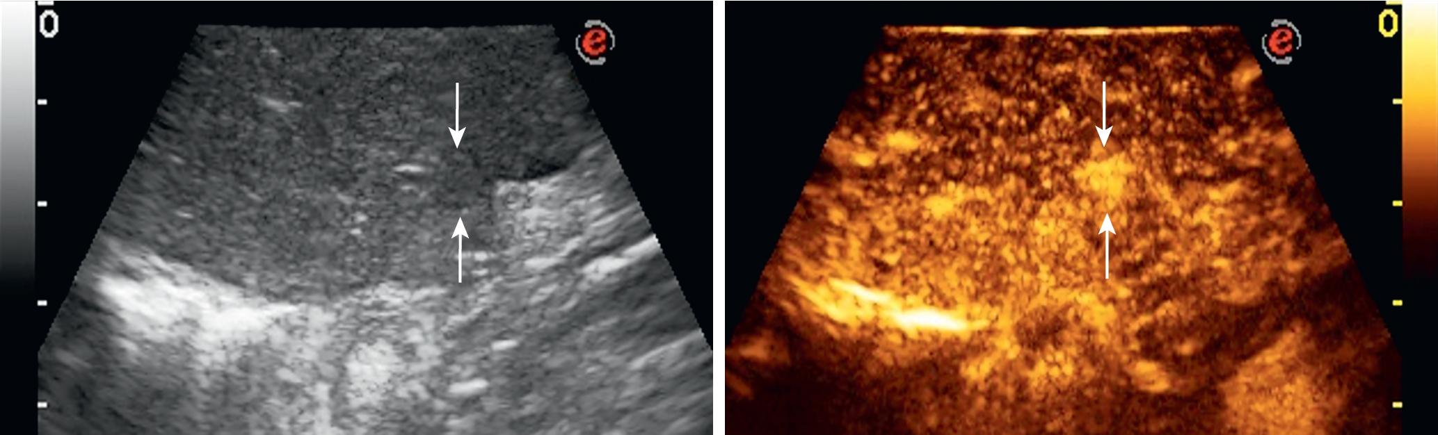 FIGURE 103.23, A, Arrows indicate a lesion. B, At early phase, the same lesions (arrows) show intranodular enhancement becoming hyperechoic, which allow its classification as an A1 nodule.
