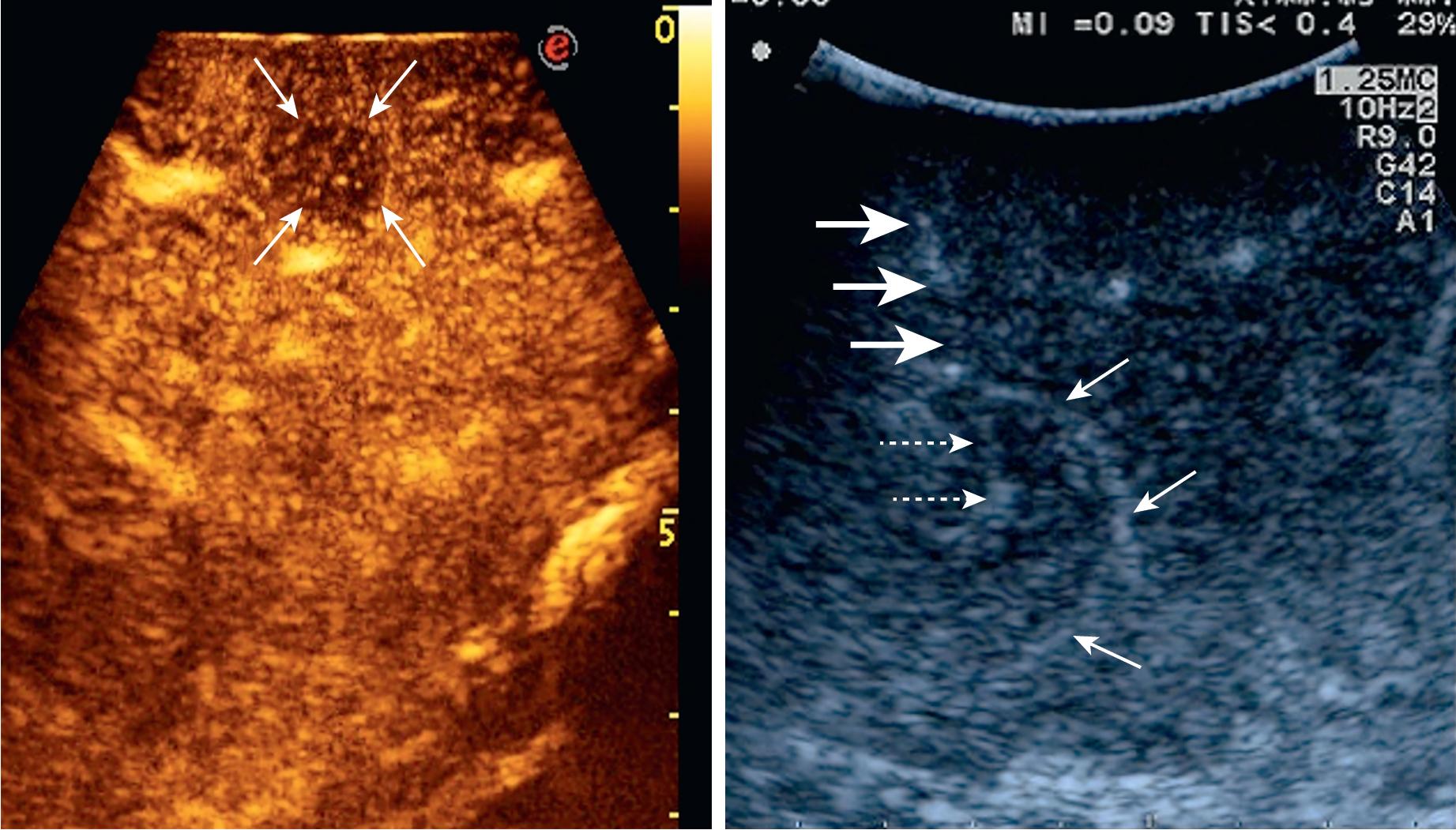 FIGURE 103.24, On the left, arrows indicate a lesion at early enhancement, which shows intranodular, hyperechoic (bright) spots, and for that is classified as an A2 nodule. On the right, a lesion at early enhancement, showing a feeding artery (thick arrows ), an artery describing a basket surrounding the nodule (arrows), and an artery which run within the tumor (dashed arrows) ; also, this lesion can be classified as A2.