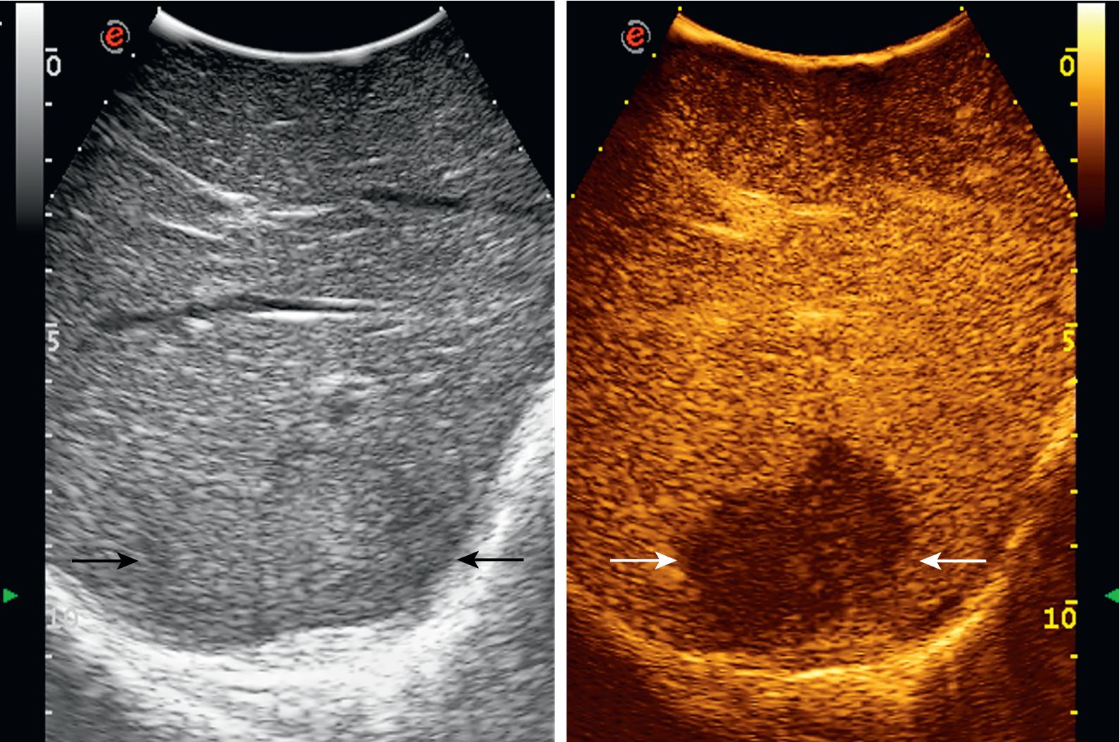 FIGURE 103.25, On the left this relatively large metastatic lesion is substantially isoechoic (black arrows) compared with the surrounding liver parenchyma. On the right, during portal phase, the lesion is clearly visible (white arrows), showing the so-called “black hole” effect.
