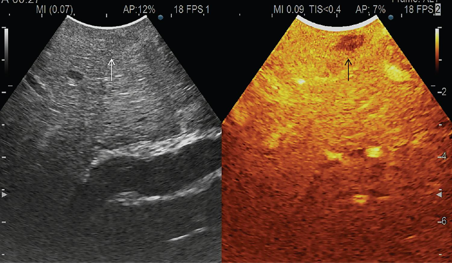 FIGURE 103.26, On the left a small metastatic lesion is isoechoic (white arrow) and almost invisible. On the right, during portal phase, the lesion is clearly visible (black arrow), showing the so-called “black hole” effect.