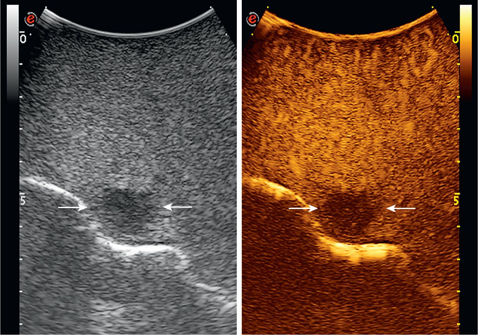 FIGURE 103.27, On the left a small metastatic lesion (arrows) in a “bright” (fatty) liver assumes a hypoechoic pattern well visible at intraoperative ultrasound (IOUS). On the right, it can be appreciated how the increment in terms of increased visibility of the lesion (arrows) during contrast-enhanced (CE)-IOUS is almost nil (see Chapter 14 ).