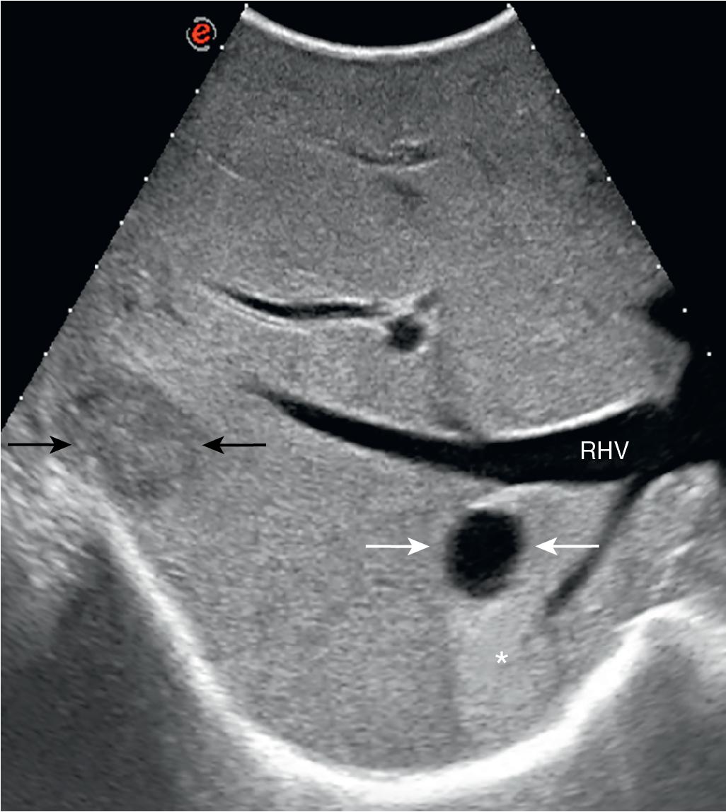 FIGURE 103.28, A small, simple hepatic cyst (white arrows) and a small metastasis (black arrows) ; the cyst is featured by a posterior echo (asterisk) and an echo-free (black) content, which is not the case of the metastasis. RHV , Right hepatic vein. (See Chapter 14 .)