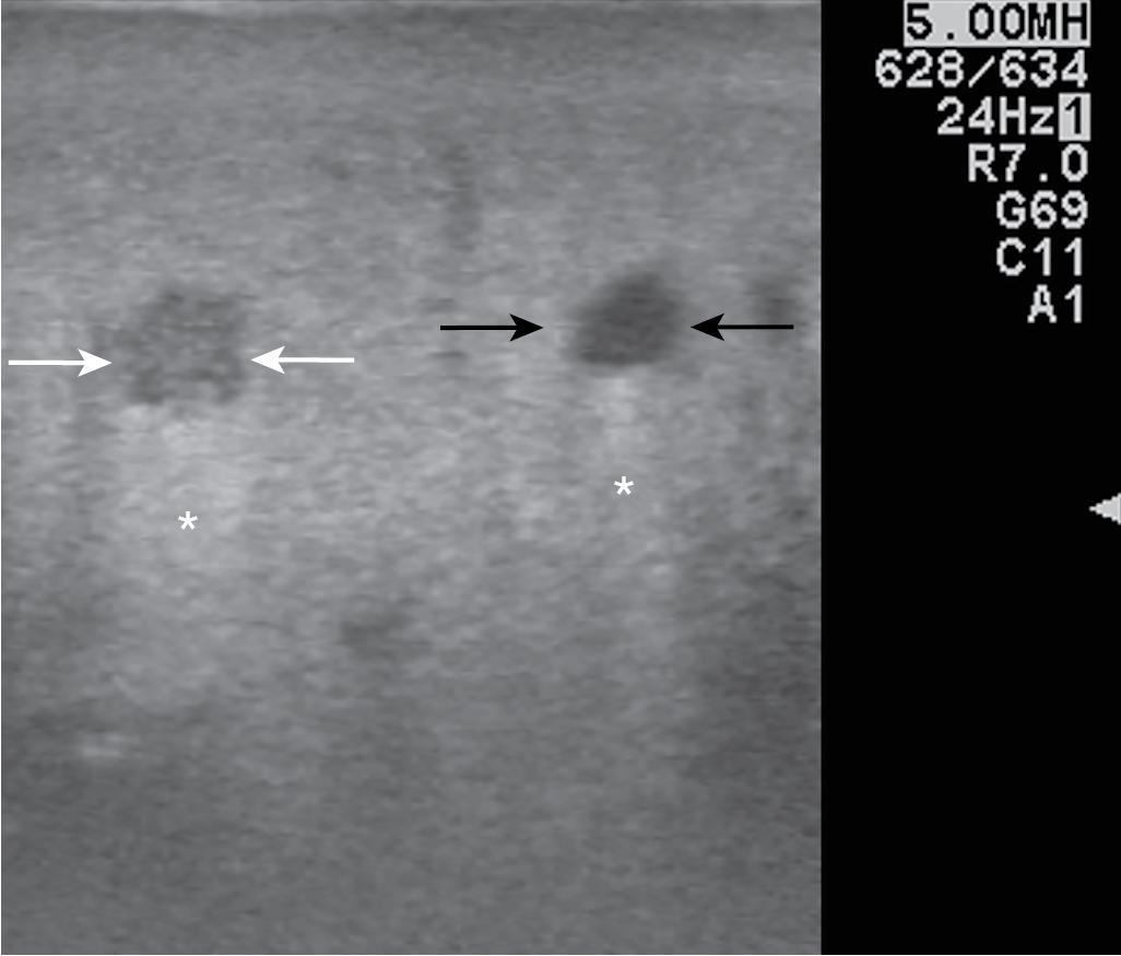 FIGURE 103.29, A small, simple hepatic cyst (black arrows) with its typical posterior echo (asterisk) and the echo-free ( black ) content. The white arrows show an ipoechoic solid lesion corresponding to colorectal metastases. (See Chapters 14 and 15 .)