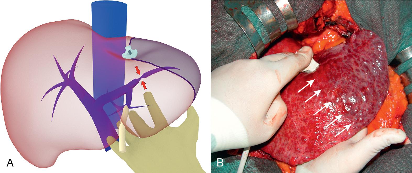 FIGURE 103.30, For segmentectomy by means of compression, the feeding portal branch is identified and compressed at the point targeted by intraoperative ultrasound ( red arrows in A ), resulting in discoloring of the segmental area ( white arrows in B ), which in this way can be marked with the electrocautery and selectively removed.