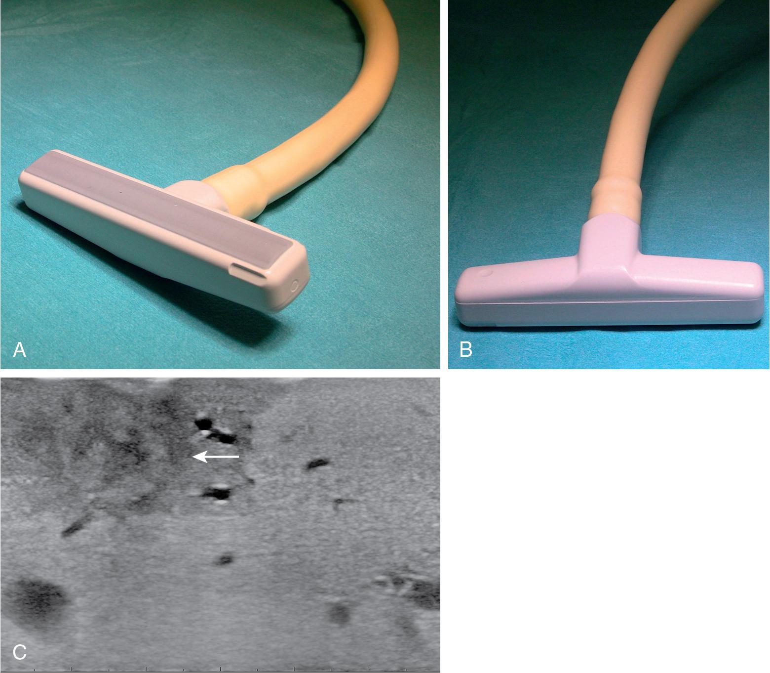 FIGURE 103.3, From left to right, the scanning side of a T-shaped echoprobe, the reverse side, and the scanning area: a small metastatic lesion is shown (arrow). This high-frequency echoprobe (7.5–10 MHz) features high resolution but low ultrasound penetration.