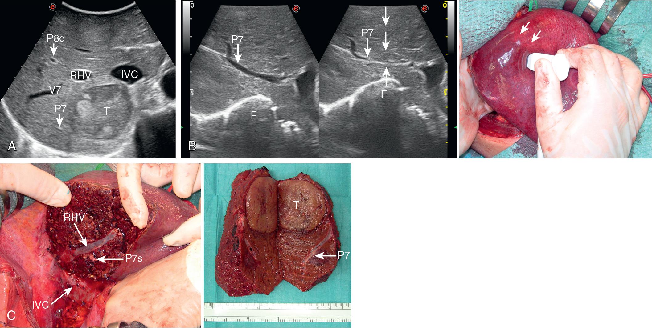 FIGURE 103.31, A, This intraoperative ultrasound (IOUS) scan shows the portal branch (P7) feeding the tumor in segment VII. B, From left to right, once identified under IOUS guidance, P7 compression is carried out (arrows) by means of the probe and the surgeon’s finger (F) positioned on the opposite side as shown on the right: The segmental area results then discolored (arrows). C, On the left, the liver after anatomic resection of segment VII showing the right hepatic vein (RHV) and the stump of P7 (P7s) on the cut surface as landmarks of a true anatomic segmentectomy; on the right, the specimen showing the tumor (T) and P7. IVC , Inferior vena cava; P8d , portal branch to subsegment VIII dorsal; V7 , hepatic veins draining segment VII.