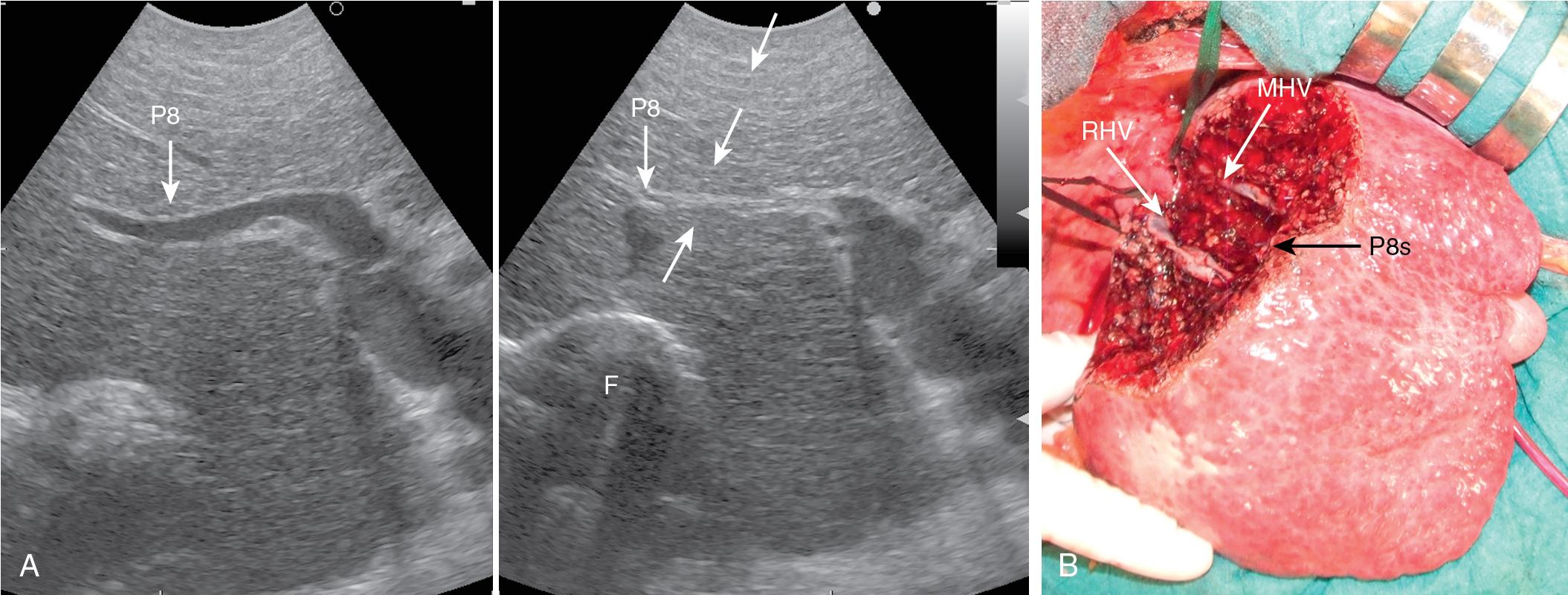 FIGURE 103.32, From left to right, intraoperative ultrasound (IOUS) scan shows the portal branch (P8) feeding the tumor in segment VIII, which is compressed under IOUS control (arrows) with the probe and the surgeon’s finger (F) positioned on the opposite side; on the right, the liver after resection of segment VIII, showing the right hepatic vein (RHV), the middle hepatic vein (MHV), and the stump of P8 (P8s) on the cut surface as landmarks of a true anatomic segmentectomy.