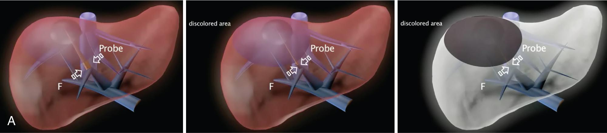 FIGURE 103.33, A, From left to right, the schema shows the compression technique with indocyanine green (ICG) counter-fluorescence, featured by the identification of the pedicle (left), its compression with parenchyma discoloring (center), the ICG-enhanced contrast between the compressed segment, and the rest of the liver (right). B, Under intraoperative ultrasound (IOUS) guidance (right-inferior box), portal pedicle to subsegment VIII dorsal (P8d) compression is carried out (arrows) with the probe and the surgeon’s finger (F) positioned on the opposite side; compression results in discoloration of the subsegment (white arrows), emphasized (white asterisk) by the ICG intravenous injection carried out by the anesthesiologist, which enhances the adjacent parenchyma (right-upper box). C, Arrows indicate the defined resection area marked on the liver surface with the electrocautery. D, Cut surface at the end of the segment VIII dorsal resection showing the right hepatic vein (RHV) with its branch draining segment VII (V7), and the stump (P8ds).