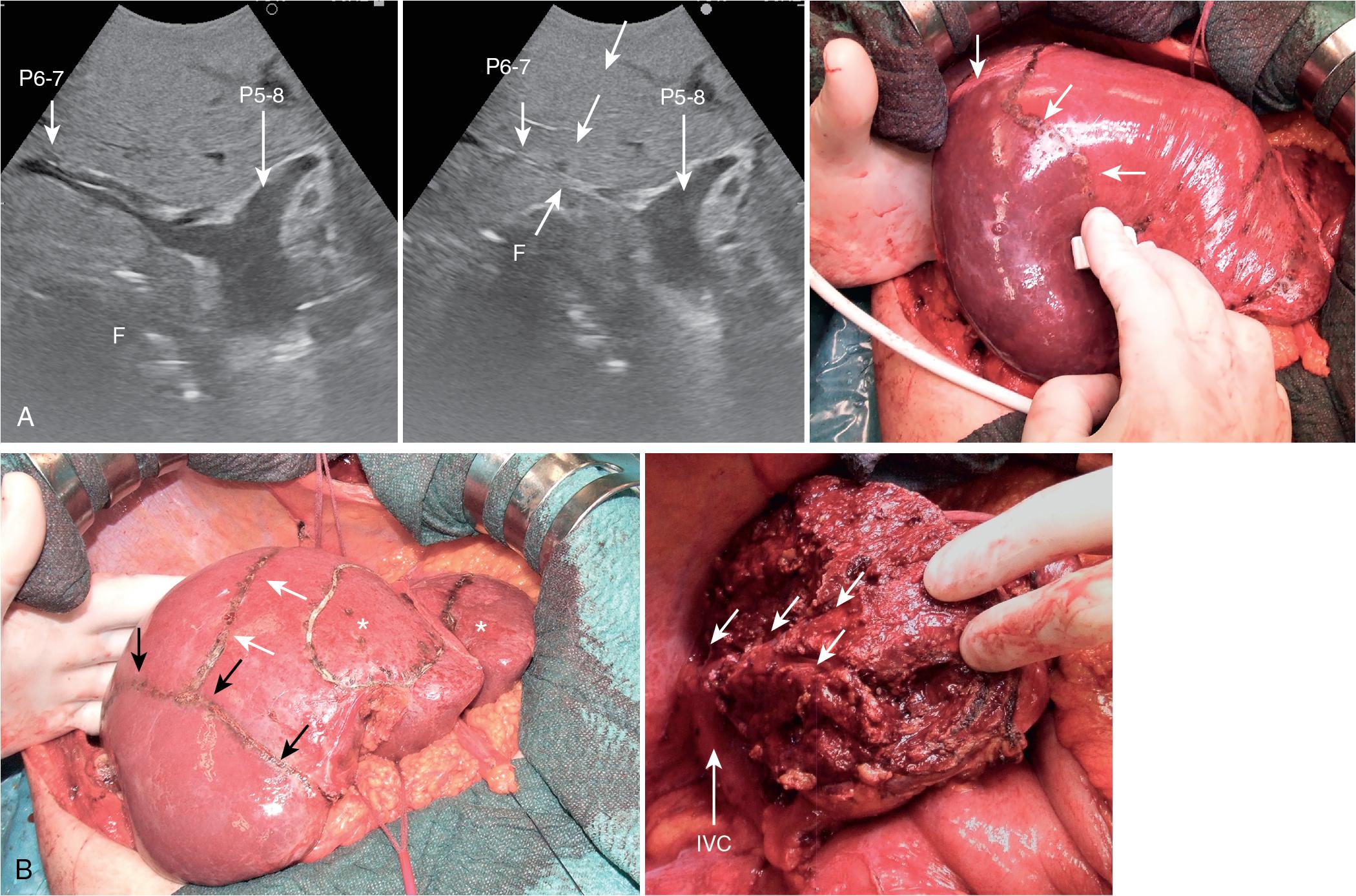 FIGURE 103.34, A, From left to right, the intraoperative ultrasound (IOUS) scan shows the sectional portal branches for the anterior (P5-8) and posterior (P6-7) sections; to disclose the margins of the right posterior section in the eventuality of a right posterior sectionectomy, under IOUS guidance, P6-7 compression is carried out (arrows) with the probe and the surgeon’s finger (F) positioned on the opposite side; compression results in discoloration of the right posterior section to be removed (arrows), and the area is marked with electrocautery. B, In this case carrier of multiple bilobar colorectal metastases, an atypical extension to segment VII (white arrows) of the area to be resected corresponding to the right posterior section (black arrows) was needed, as were associated other resections areas in the left hemiliver (asterisks) ; the cut surface previously of the liver at the end of the extended right posterior sectionectomy: Arrows indicate the right hepatic vein (RHV) fully exposed. IVC , Inferior vena cava.