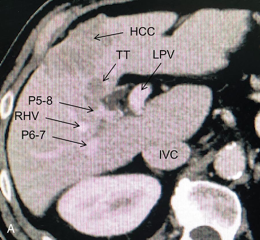 FIGURE 103.35, A, Computed tomography (CT) slice showing a hepatocellular carcinoma (HCC) with infiltrative growing pattern with a tumor thrombus (TT) occupying the portal pedicle to the right anterior section ( P5-8 ; see Chapter 14 ). B , Virtual cast based on the CT images with the lesion in green. C , IOUS image of the TT occluding P5-8 and bulging into the right portal vein (RPV). D, From left to right, isolation of the proper hepatic artery (PHA), which is clamped before indocyanine green (ICG) intravenous injection carried out by the anesthesiologist; after clamping the PHA and injecting ICG, the right anterior section remains dark (white arrows) while the area beside the liver enhances and the resection area is marked (white dotted lines). E , Resection is carried out, exposing both the right (RHV), and the middle hepatic vein (MHV) ; the right posterior Glissonean pedicle (P6-7) is preserved, and P5-8 is resected (P5-8s) after having cleared by means of peeling off technique of the right portal vein. 69 IVC , Inferior vena cava