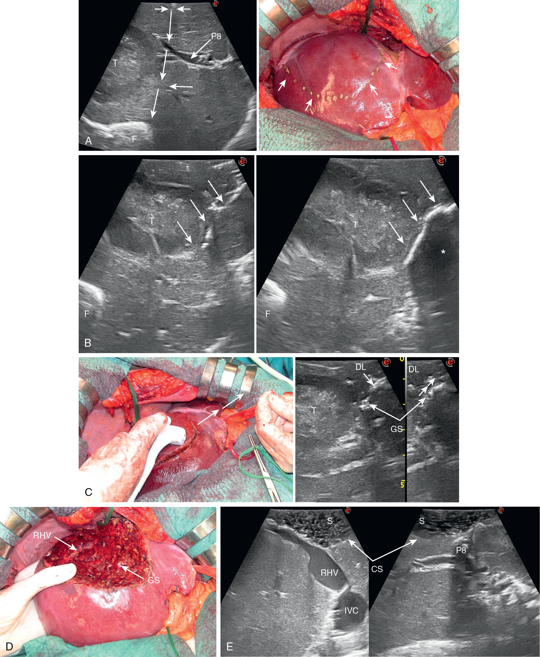 FIGURE 103.36, A, On the left, both the shadow generated by the electrocautery (thick arrows) and the profile of the surgeon’s finger (F) are visualized, and the surgeon can draw an ideal dissection plane (arrows) that can be followed as shown on the right once the resection area is marked using these landmarks (arrows). B, Dissection is carried out and followed by intraoperative ultrasound (IOUS) just targeting the surgeon’s fingertip (F) ; the dissection line is visualized, as shown on the left, taking stock of the air and clots trapped between the faced cut surfaces (arrows) , or, as shown on the right, by using a gauze interposed between the faced cut surfaces (arrows). The first method makes less evident the dissection line, while the second, although making the dissection line clearer, masks with its posterior echo (*) the deeper structures. C, Once during dissection a vessel is encountered and encircled with suture, its discrimination between a vessel that should be preserved or divided can be done by adopting the so-called “hooking technique.” Particularly in the case of the bifurcation between portal branch to segment V and segment VIII, the encircled vessel is pulled up by the stitch (arrows) and at intraoperative ultrasound (IOUS) the visualization of the traction point makes sure which vessel is the one encircled, then it is preserved or divided, accordingly. D, The cut surface at the end of the resection showing the right hepatic vein (RHV) exposed, and the ligated Glissonean sheath ( GS ) of the limited resection with exposure of the tract of the MHV, which was in contact with the lesion. E, The cut surface (CS) of the end of the resection can be checked at IOUS for verifying the eventual presence of residual disease by putting some saline on it (S). DL , Dissection line; IVC , inferior vena cava; P8 , portal branch to segment VIII.