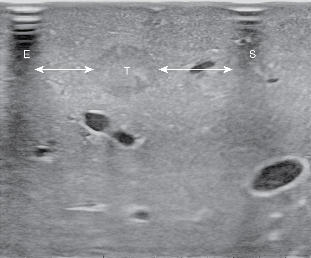 FIGURE 103.37, Intraoperative ultrasound shows both the electrocautery (E) and the scar (S). A vertical shadow is generated that allows verification of the proper margins of resection in relation to the tumor (T) location (arrows).